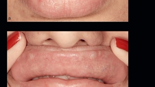 آیا در مان ندول(گره گلوله شده) با هیالاز کار درستی هست?