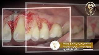 فیلم جراحی پیوند لثه دو دندان در فک بالا
