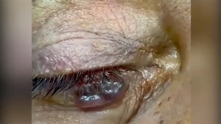 جراحی حذف تومور بدخیم پلک تحتانی