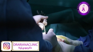 ژنیکوماستی در ورزشکار تیم ملی