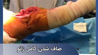 فیلم جراحی روماتیسم زانو