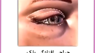 هزینه جراحی پلک چقدر است؟ رفع افتادگی پلک