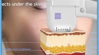 هایفوتراپی معجزه جوانسازی و لیفت صورت/ هزینه و مزایا دندان شیری