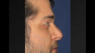 نتیجه عمل زیبایی بینی 15 سال پس از جراحی
