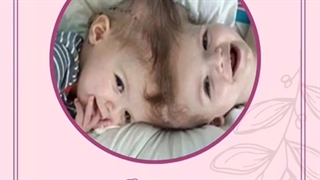 دو قلوی بهم چسبیده