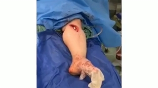 عمل استئوتومی