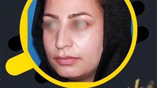 آیا عمل بینی گوشتی بازگشت دارد؟