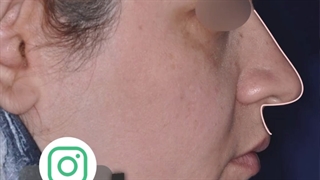 نمونه واقعی عمل بینی در مشهد