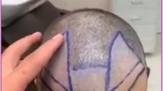 کاشت مو به روش BHT