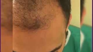 کاشت مو در جای زخم و بخیه با چه روشی امکان پذیر است؟