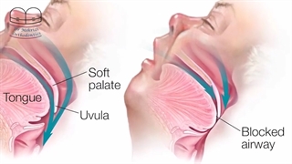 ناهنجاری فک و اختلال خواب | دکتر احسان ابولی مهریزی