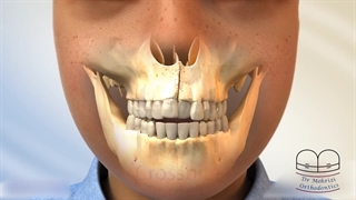 درمان تنگی عرض فک بالا | دکتر احسان ابوئی مهریزی