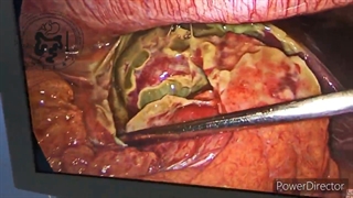 گانگرن یا سیاه شدن کیسه صفرا