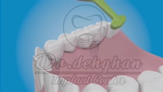 دکتر وحید دهقان: چگونه دندان ایمپلنت را مسواک بزنیم