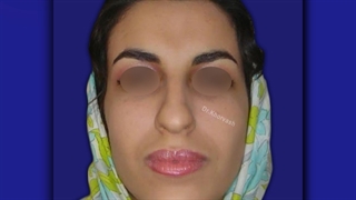 جراحی زیبایی بینی | دکتر خوروش