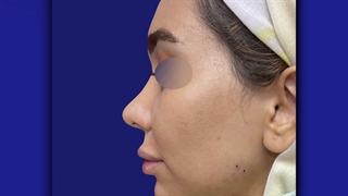 بلافاصله پس از زاویه سازی صورت و تزریق ژل لب | دکتر خوروش