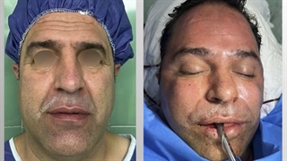 لیفت باز پیشانی ، صورت و گردن | دکتر خوروش