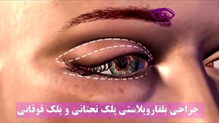 جراحی بلفاروپلاستی پلک تحتانی و پلک فوقانی