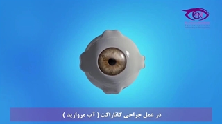 جراحی کاتاراکت