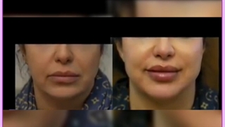 راهکار قطعی از بین بردن خط خنده با تزریق ژل دندان مصنوعی
