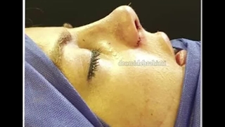 بلافاصله پس از عمل بینی گوشتی | دکتر امید ابراهیمی