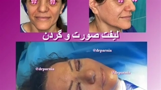 لیفت صورت و گردن