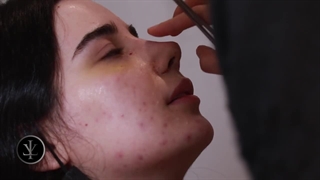 نمونه جراحی بینی و نحوه چسب زدن