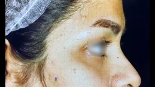 فیلم جراحی بینی- کوچک کردن و قرینه سازی سوراخ بینی