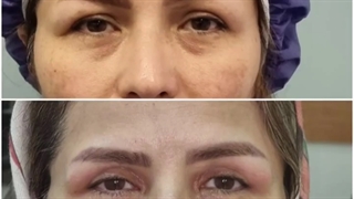 فیلم واقعی از بلفاروپلاستی پلک بالا