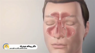 سینوزیت مزمن