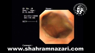 دیورتیکول مری