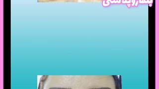 بلفارو پلک چیست