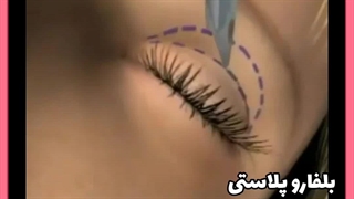 آموزش جراحی پلک