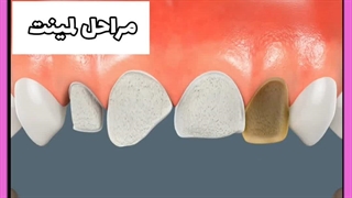 عمر لمینت دندان