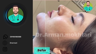 فیلر چانه اصلاح طرح لبخند