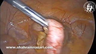 سوختگی تصادفی روده با لیگاشور