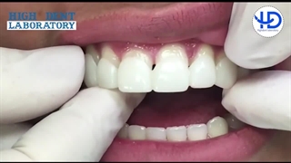 لمینت متحرک یا اسنپ اسمایل چیست؟