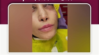 تزریق فیلر زیر چشم