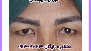 بلفاروپلاستی