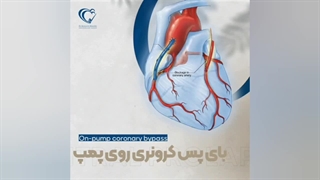 جراحی بای پس عروق کرونری روی پمپ