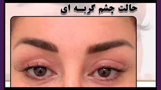 بلفاروپلاستی به روش چشم گربه‌ای