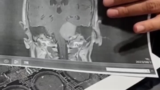 مننژیوم سی پی انگل | انواع، درمان و پیشگیری